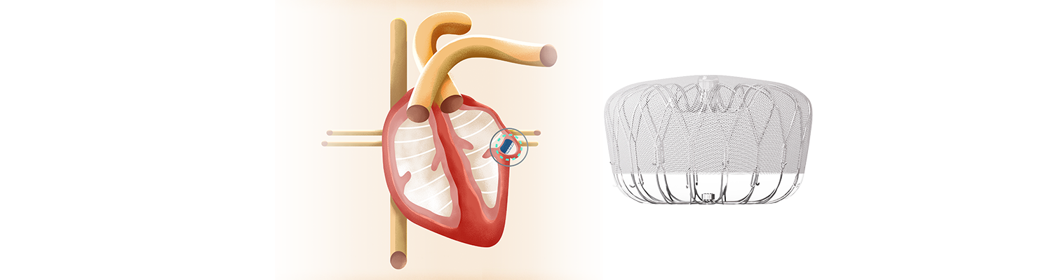 watchman device and heart placement