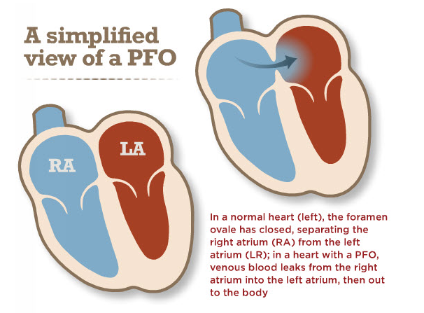 Structural Heart Disease - Patent Foramen Ovale | Catholic Medical Center